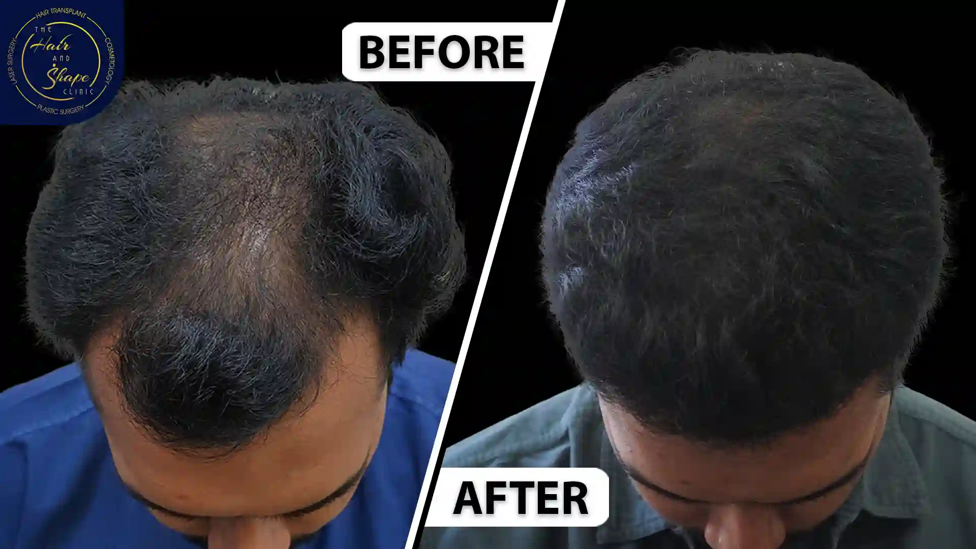 Hair Transplant result8